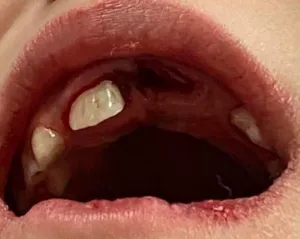 Picture of knocked out (Avulsed) tooth in child patient