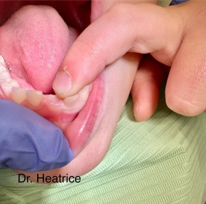 upclose photo of a mouth